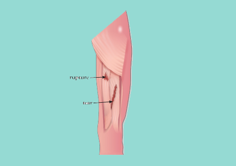 Hamstring Injuries